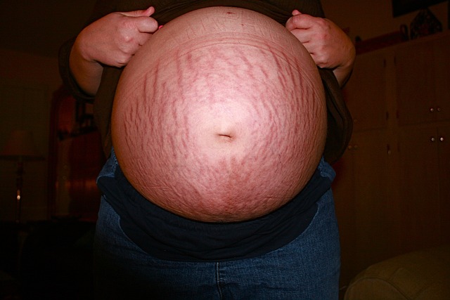 Huge stretch marks in pregnancy