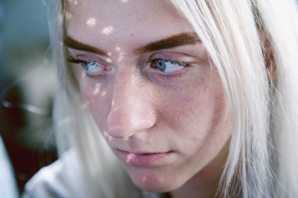 Acne vulgaris is common among teens